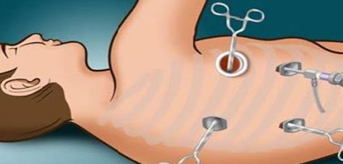 Paediatric Thoracoscopy